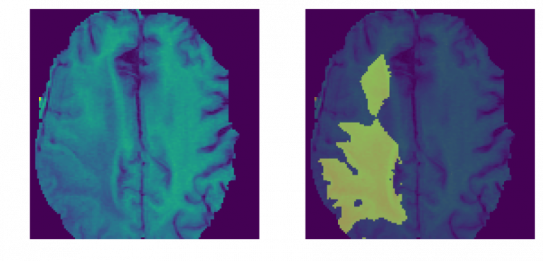 An image showing two photographs of brain scans. One is an MRI Scan and the other shows a Tumor Indication.