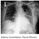 x-ray example of edema consolidation pleural effusion