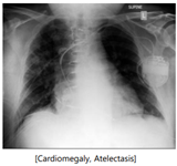 x-ray example of cardiomegaly atelectasis
