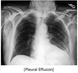 x-ray example of pleural effusion