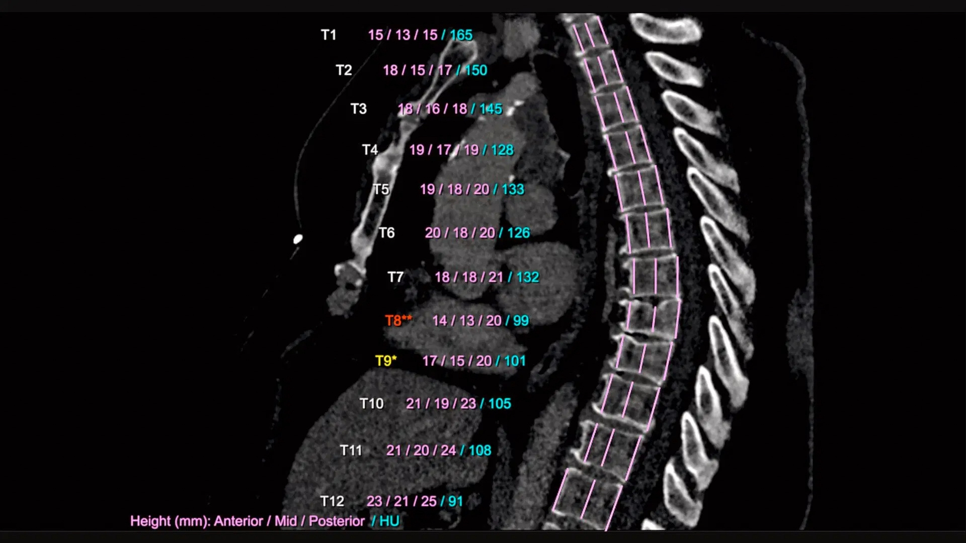 An image shows an AI scan of a spinal column. The height of each vertebra is measured and compared. Siemens Healthineers’ AI-Rad Companion Chest CT automatically processes these measurements and marks abnormalities with easy-to-understand color-coding. Deviations are highlighted in red and yellow, and bone density is reported. (Credit: Siemens Healthineers via Klinikum Nürnberg, Nuremberg, Germany)